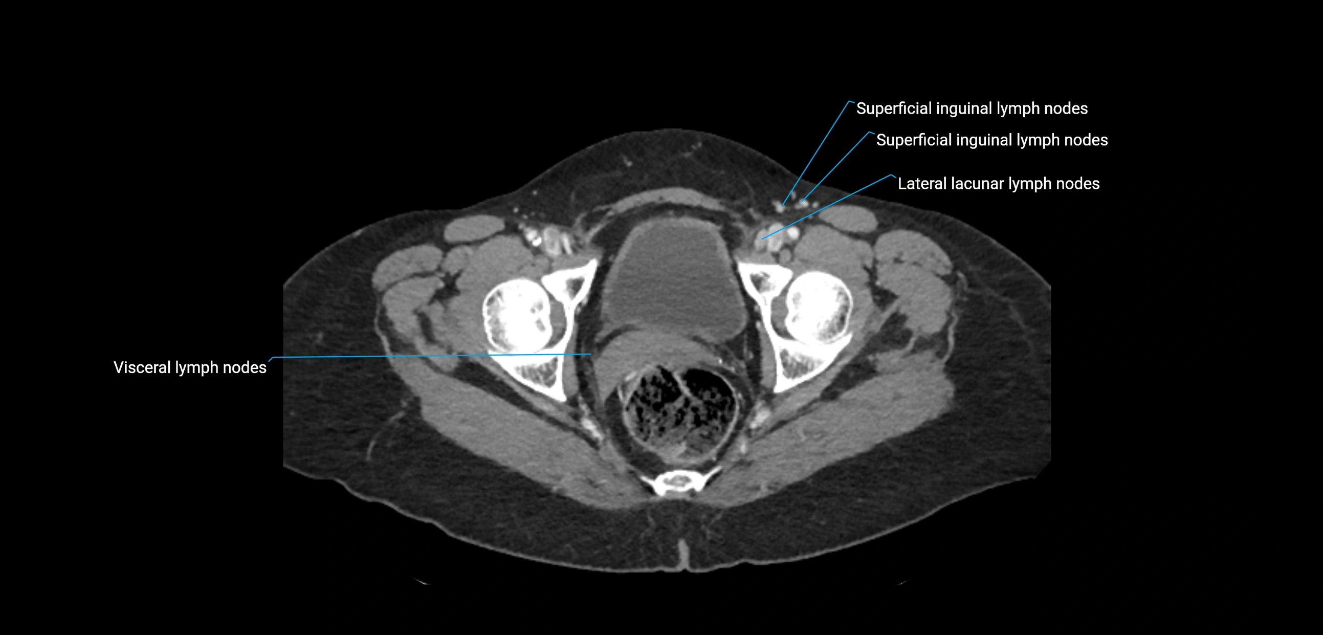 CT ct abdominal lymph nodes  axial cross sectional anatomy  enchanced radiology image -img-00002-00391.webp